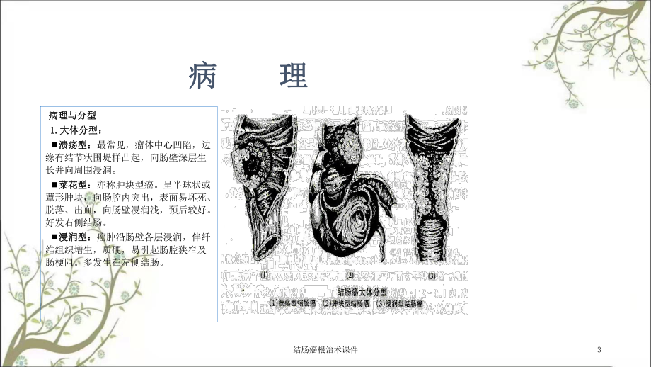 结肠癌根治术课件.ppt_第3页