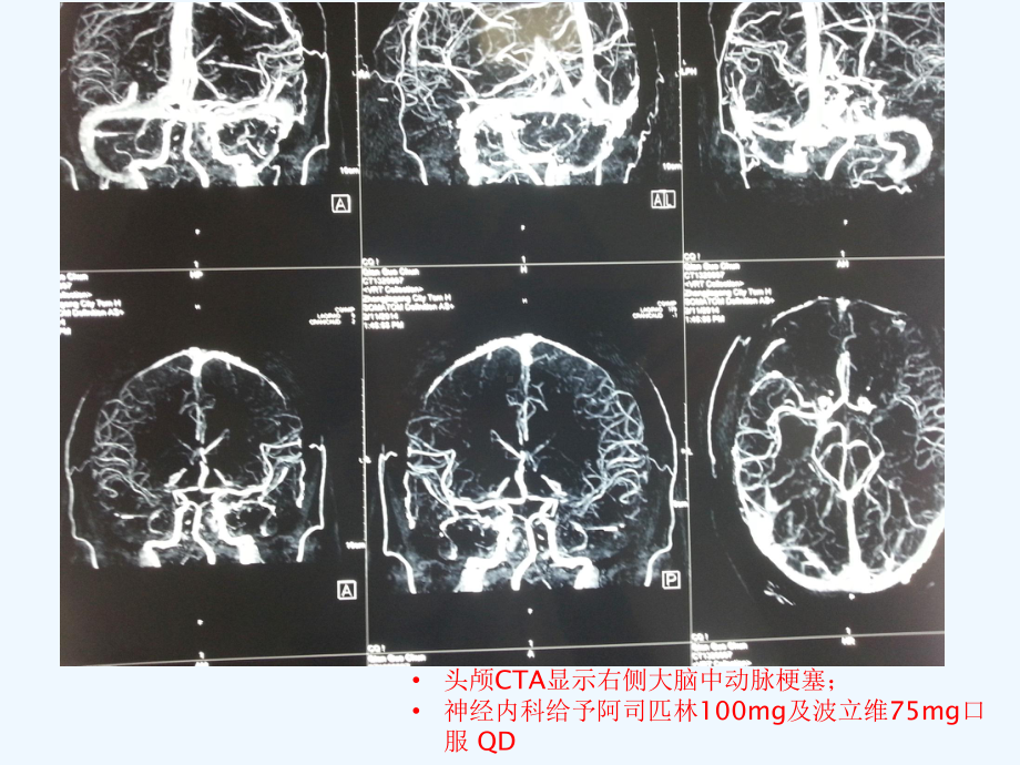 神经外科患者围手术期出血及凝血功能障碍处理课件.ppt_第3页