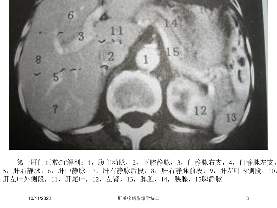 肝脏疾病影像学特点培训课件.ppt_第3页