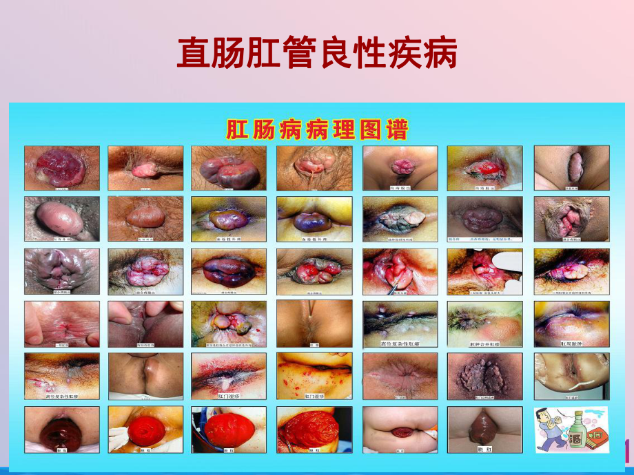 直肠肛管疾病病人的护理片课件.ppt_第3页