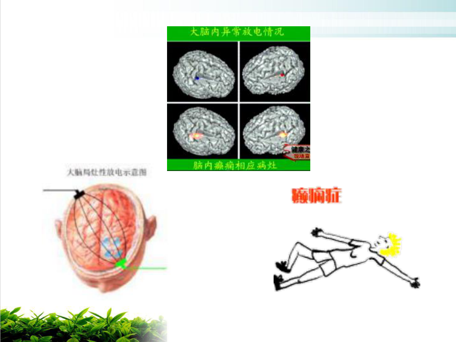 第十四抗癫痫药和抗惊厥药精选课件.ppt_第3页