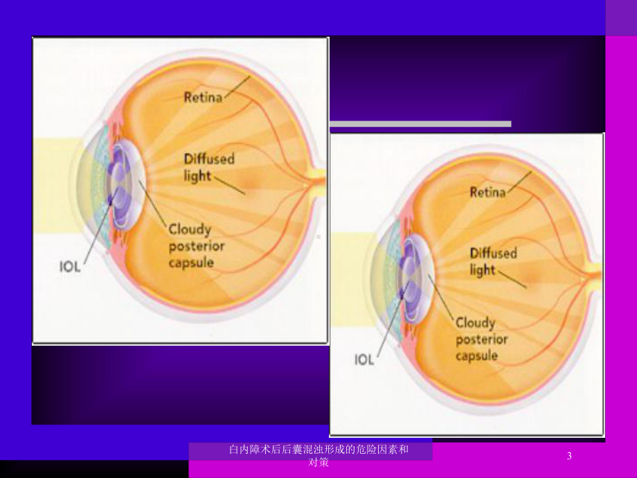 白内障术后后囊混浊形成的危险因素和对策培训课件.ppt_第3页