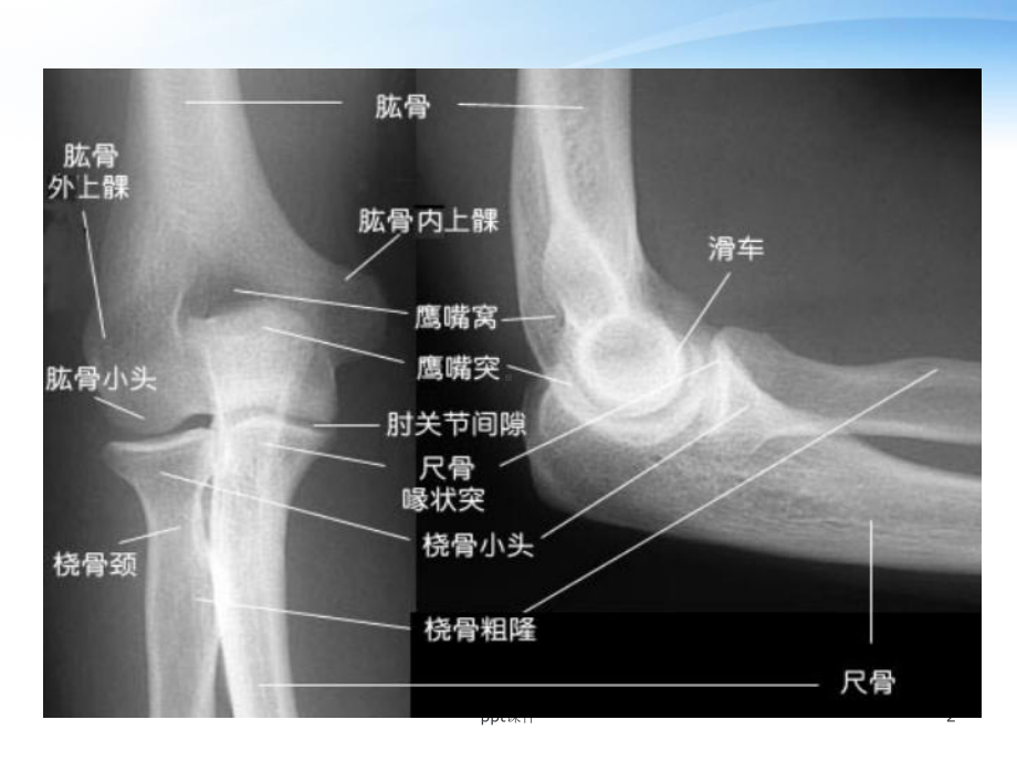 肘关节脱位-课件.ppt_第2页