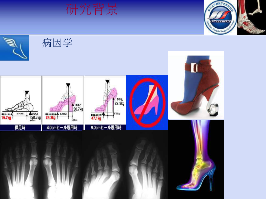 第一跖楔关节融合在拇外翻治疗中的原理及疗效分析概要课件.pptx_第3页