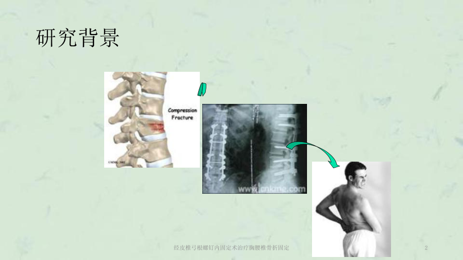 经皮椎弓根螺钉内固定术治疗胸腰椎骨折固定课件.ppt_第2页