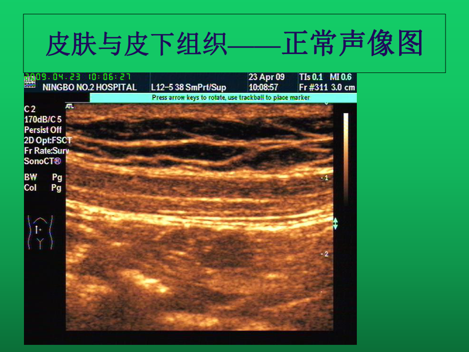 皮肤软组织肿块超声诊断课件.pptx_第3页