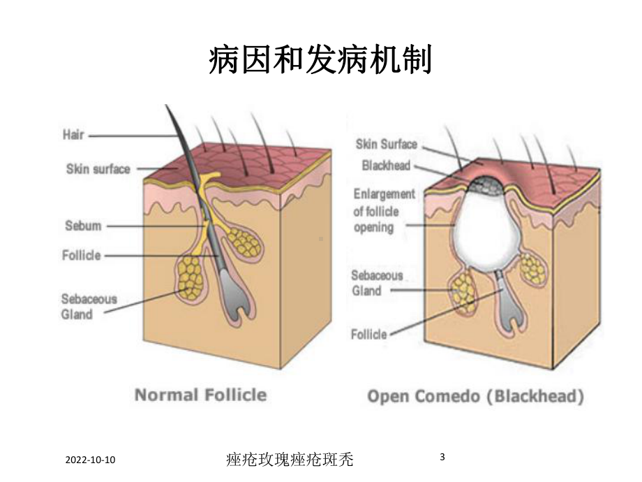 痤疮玫瑰痤疮斑秃培训课件.ppt_第3页