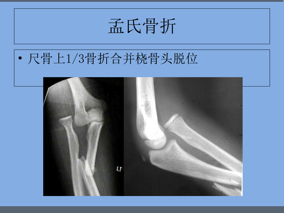 盖氏骨折的分类及治疗-课件.ppt_第2页