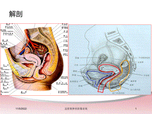 盆腔脓肿的影像表现培训课件.ppt