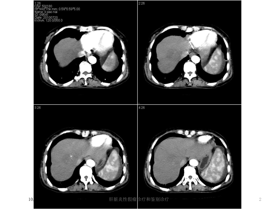 肝脏炎性假瘤诊疗和鉴别诊疗培训课件.ppt_第2页