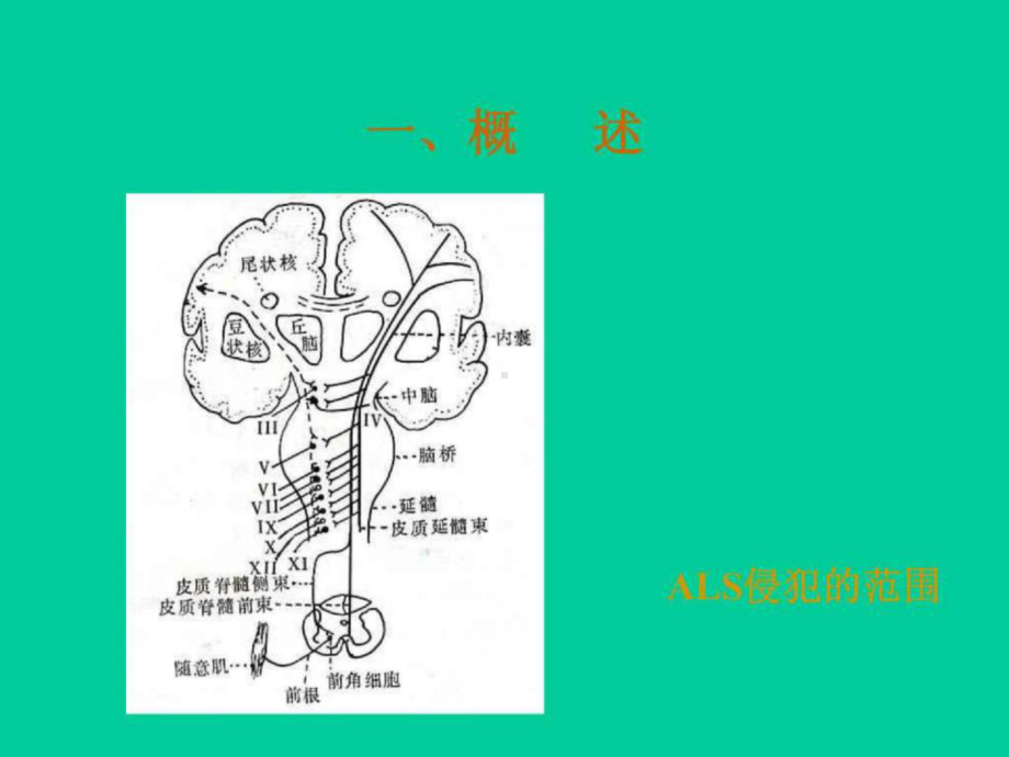 肌萎缩性侧索硬化的若干课件.ppt_第2页