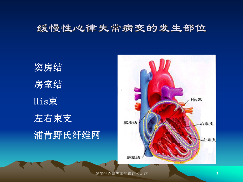 缓慢性心律失常的诊疗和治疗培训课件.ppt_第3页