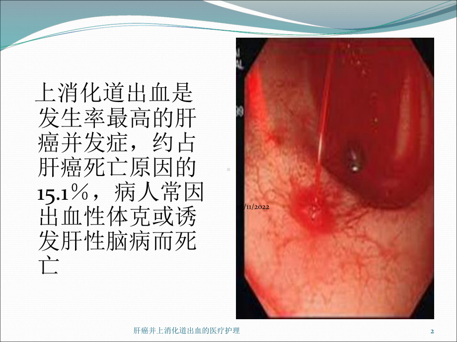 肝癌并上消化道出血的医疗护理培训课件.ppt_第2页