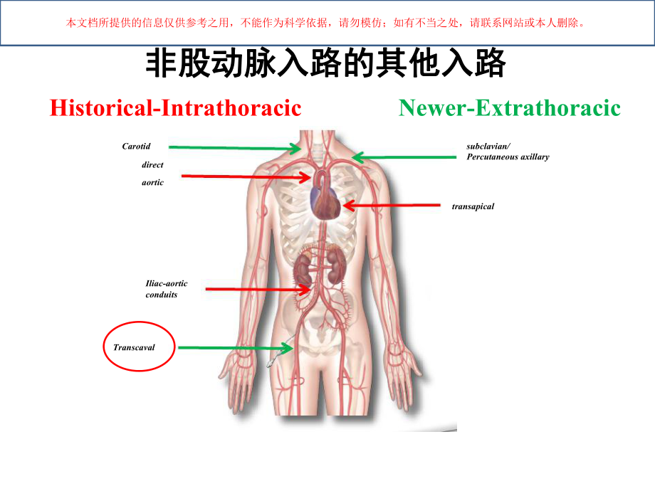 经腔静脉主动脉入路TAVR培训课件.ppt_第3页