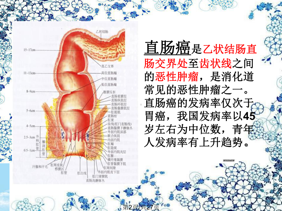 直肠癌及护理全面版课件.pptx_第2页