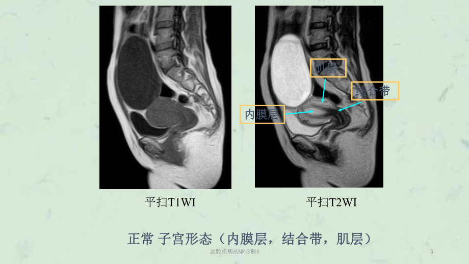 盆腔疾病的MR诊断6课件.ppt_第3页