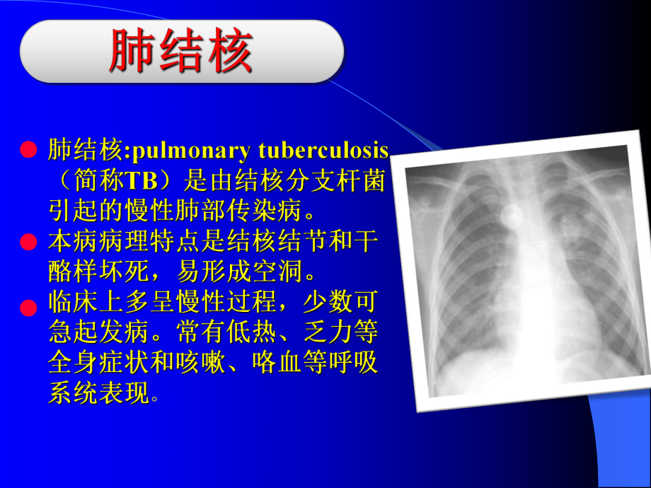 结核病简明现代医学课件.ppt_第3页