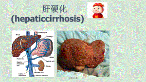 肝硬化完整课件.ppt