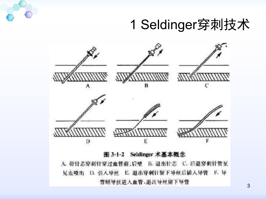 ICU常用操作技术参考课件.ppt_第3页