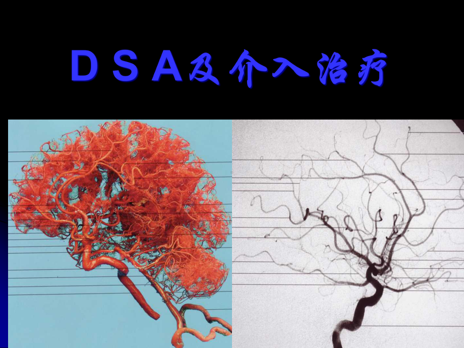 DSA介入治疗课件.ppt_第1页