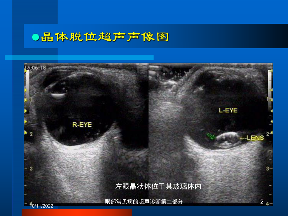 眼部常见病的超声诊断第二部分培训课件.ppt_第2页