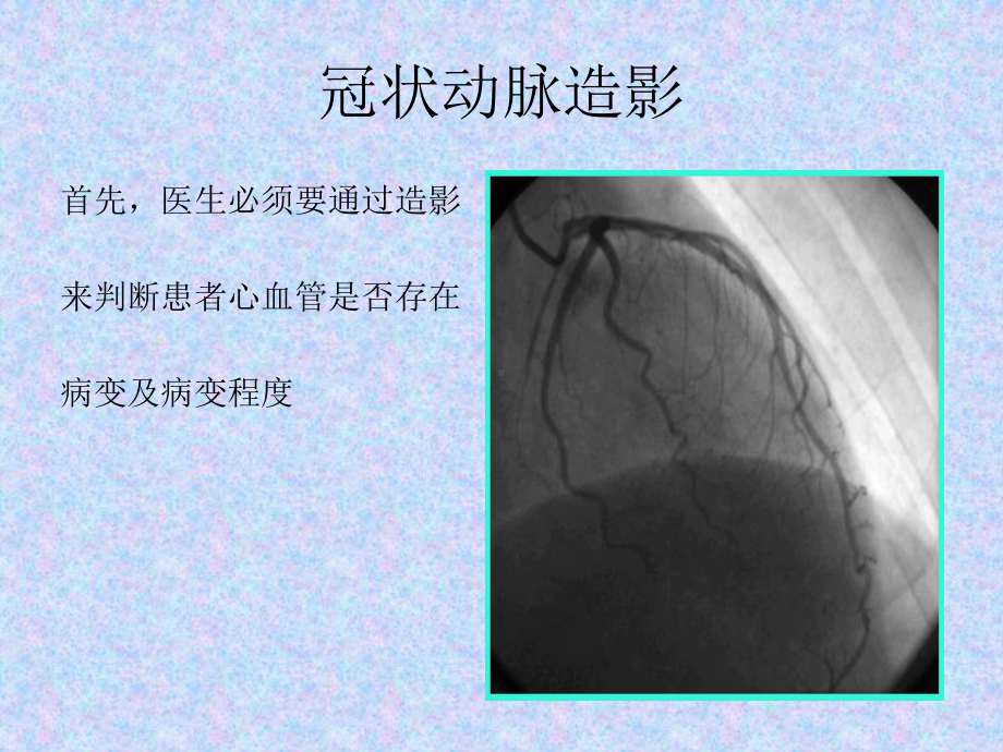 经皮冠状动脉介入治疗的手术流程和器材选择主题讲座课件.ppt_第2页