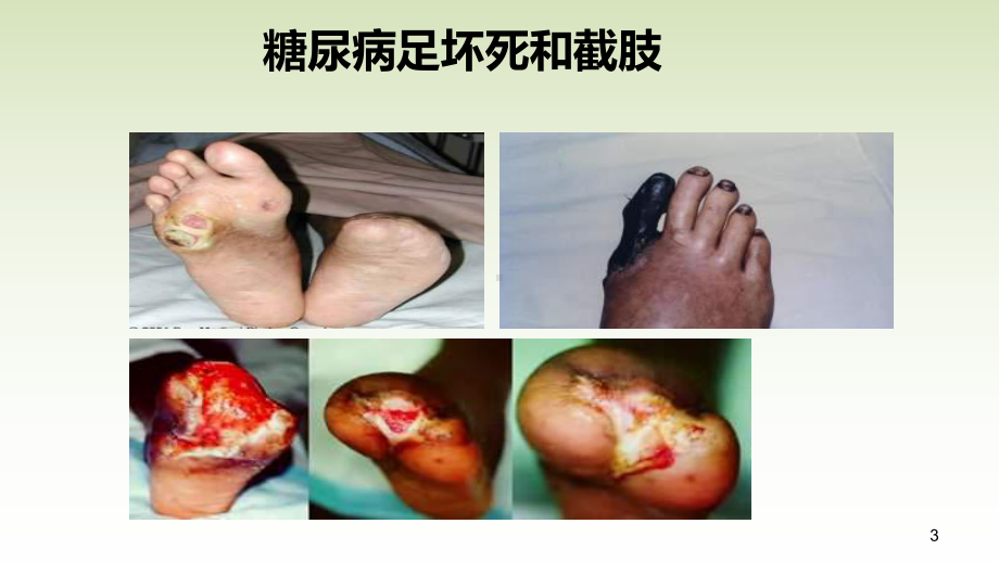 糖尿病健康教育糖尿病足课件.ppt_第3页