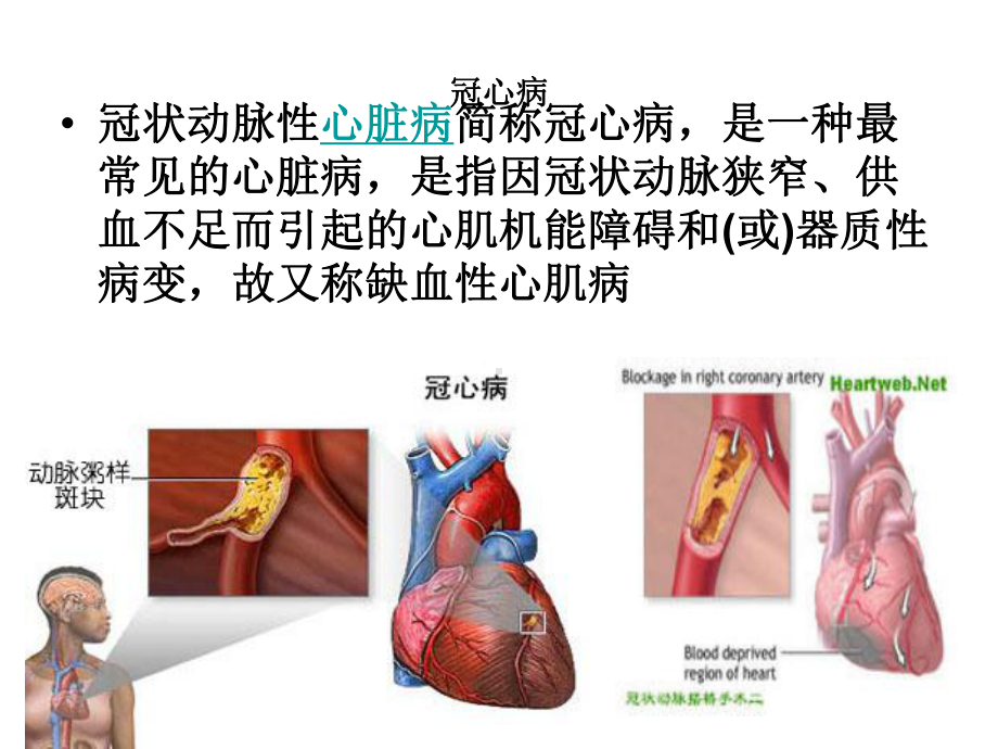 老年医学保健-第六讲冠心病课件.pptx_第3页