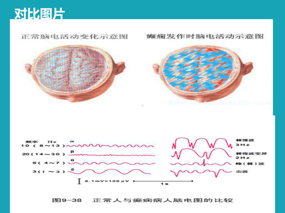 癫痫发病机制及临床表现课件.ppt_第3页