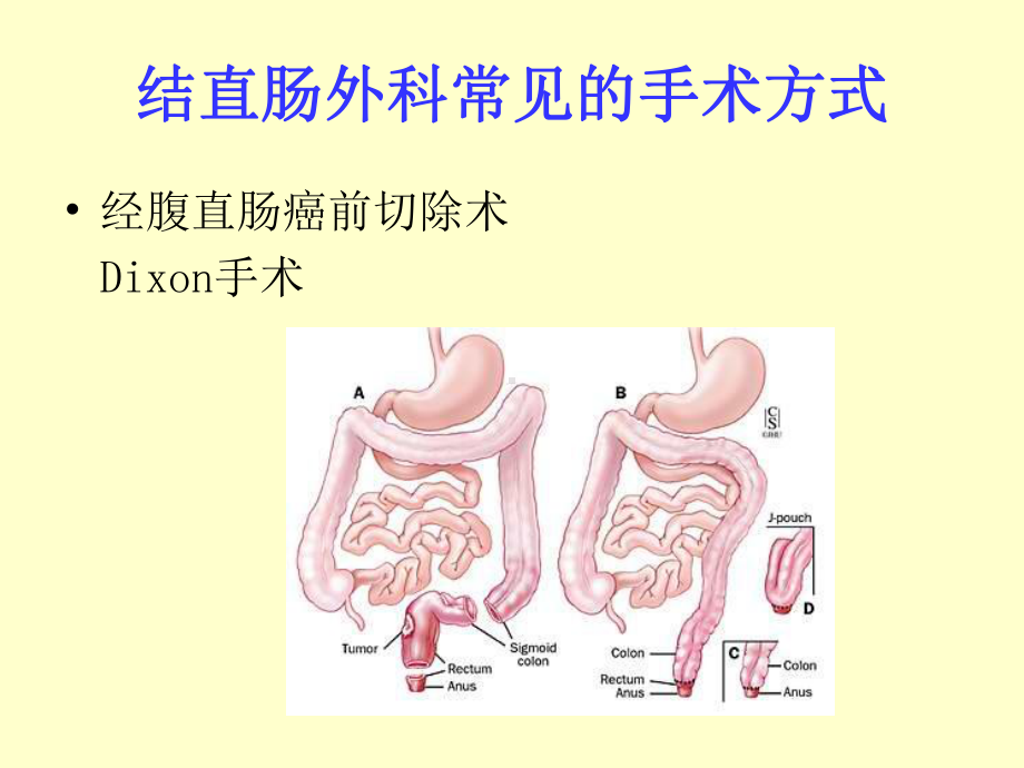 结肠造口与其护理课件.pptx_第3页