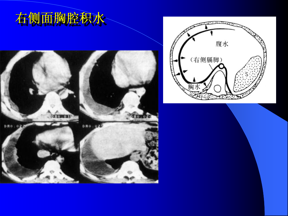 CT诊断课件-胸腹水.ppt_第2页