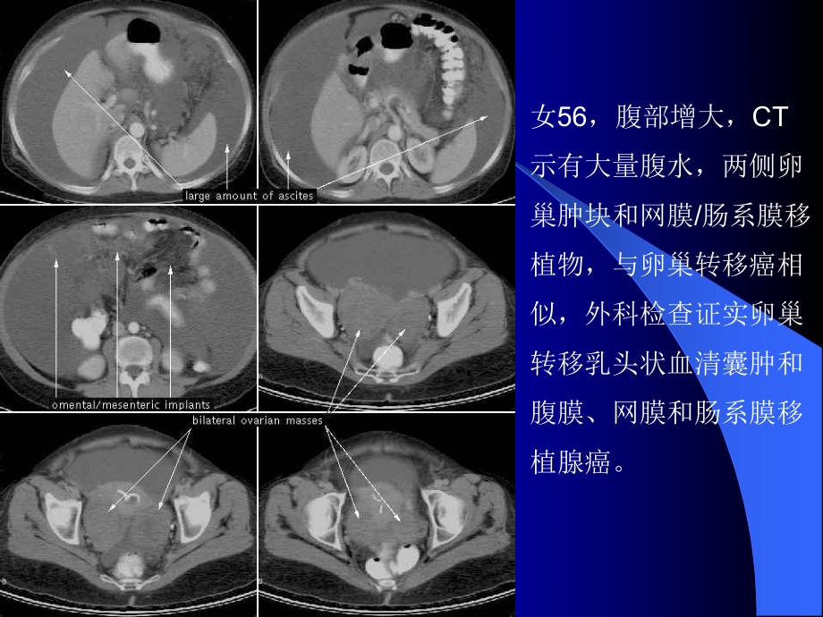 CT诊断课件-胸腹水.ppt_第3页