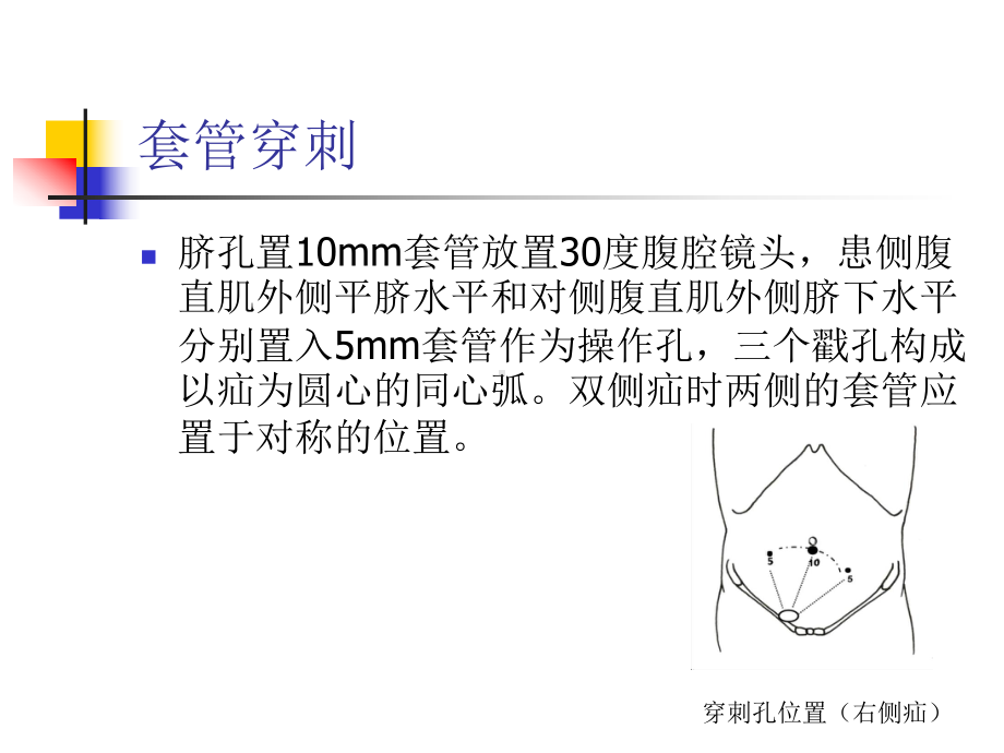 TAPP手术技巧课件.pptx_第2页