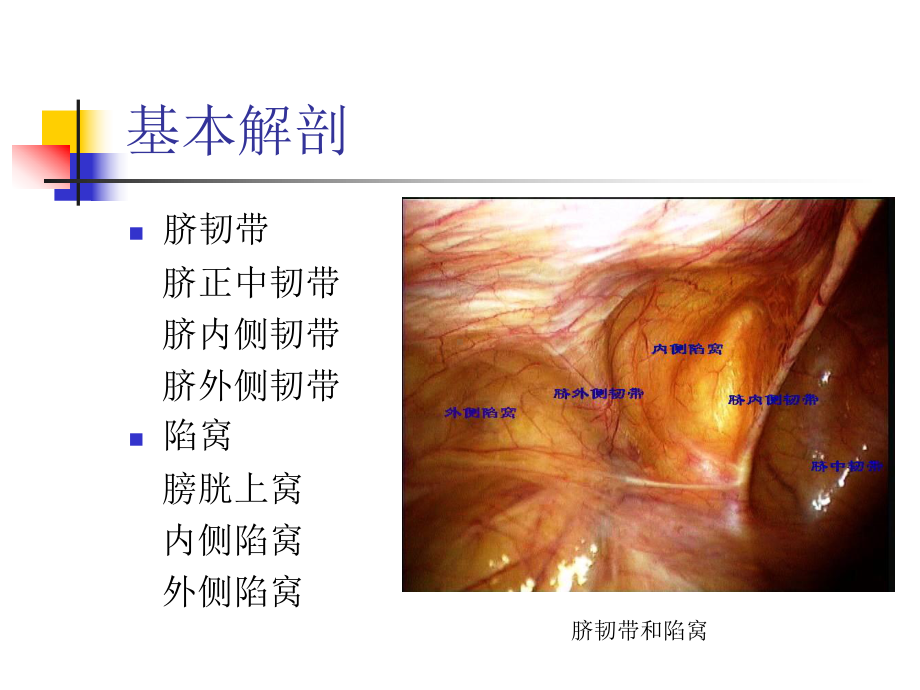 TAPP手术技巧课件.pptx_第3页