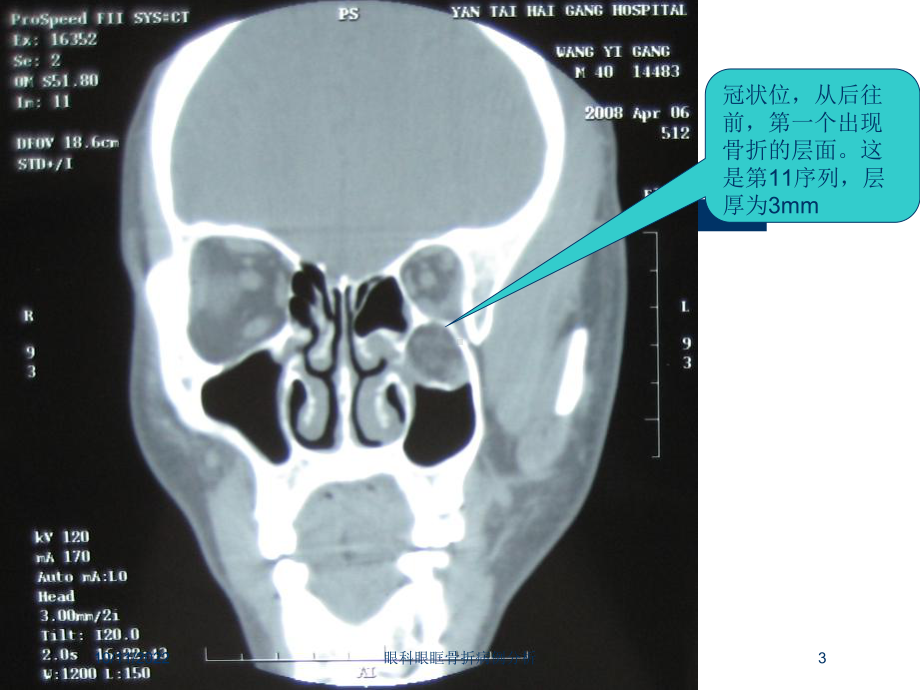 眼科眼眶骨折病例分析培训课件.ppt_第3页