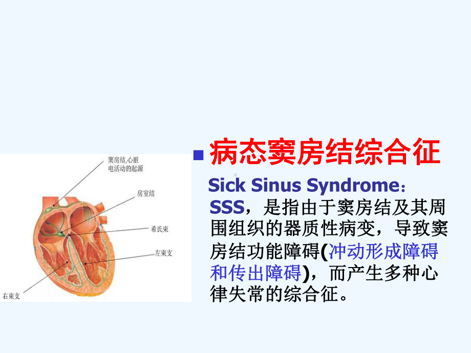 病窦综合征护理查房课件.ppt_第2页