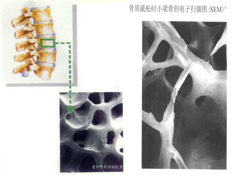 老年性骨质疏松及椎体成形术培训课件.ppt_第3页