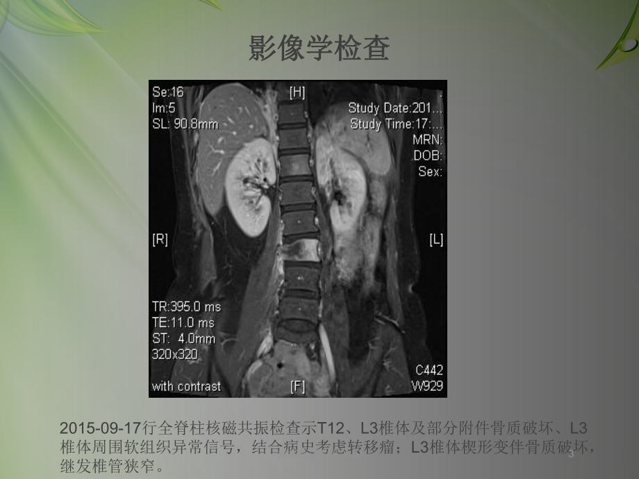 癌痛病例医学知识培训课件.ppt_第3页