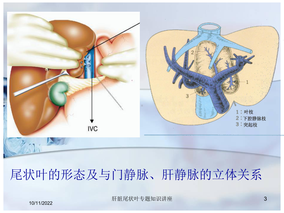 肝脏尾状叶专题知识讲座培训课件.ppt_第3页