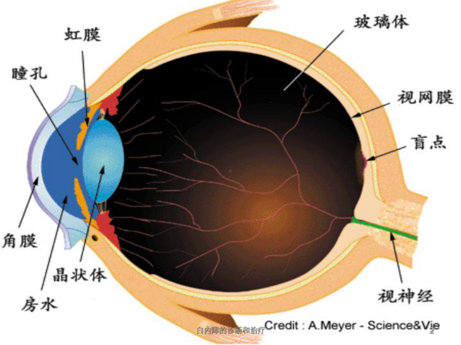白内障的诊断和治疗培训课件.ppt_第2页