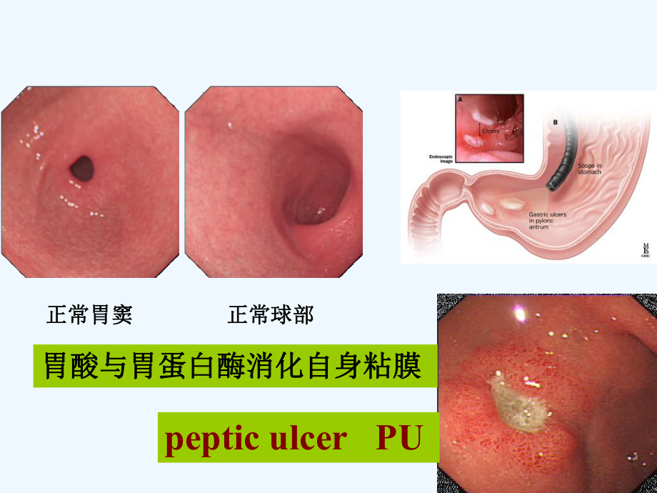 第八版消化性溃疡课件.ppt_第2页