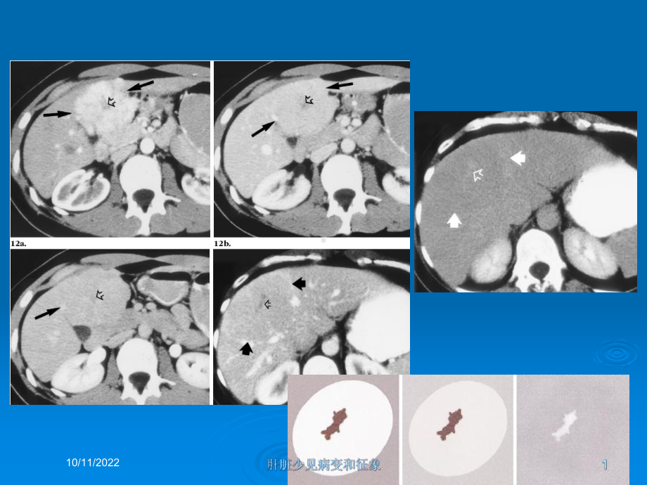 肝脏少见病变和征象培训课件.ppt_第1页