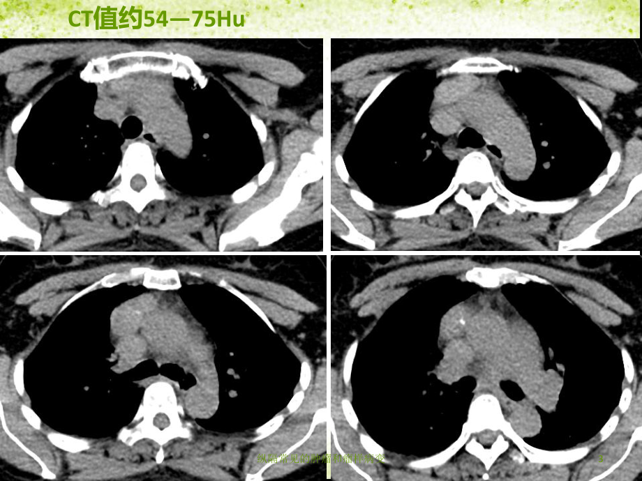 纵隔常见的肿瘤和瘤样病变培训课件.ppt_第3页