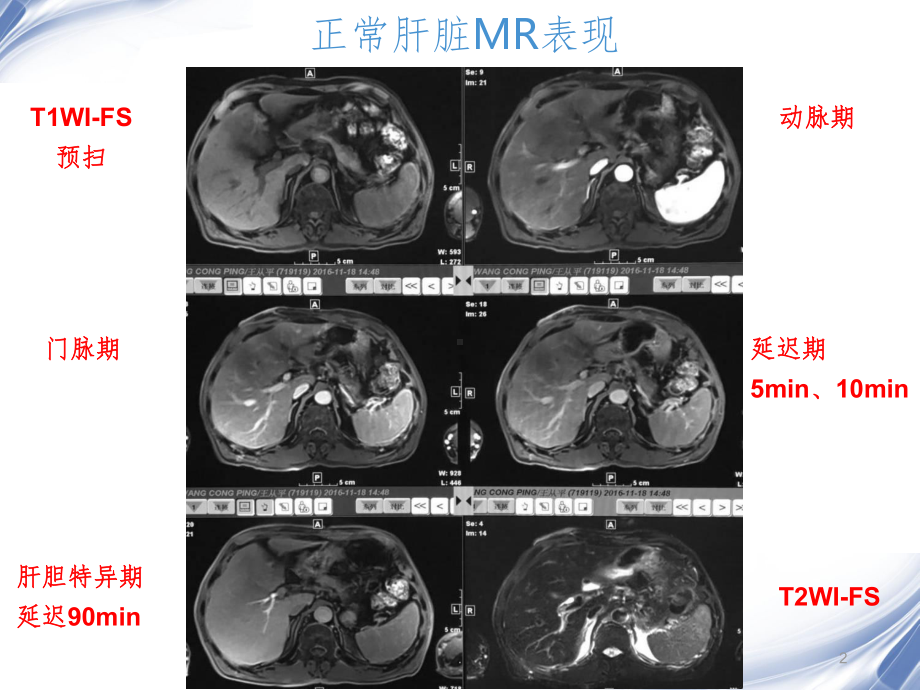 肝脏的MR表现课件.ppt_第2页