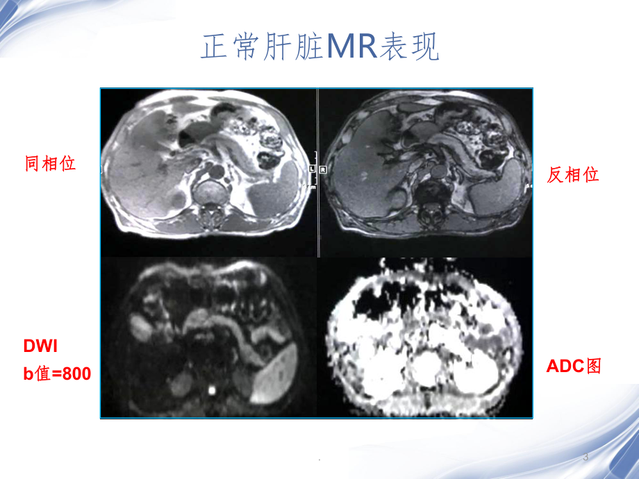 肝脏的MR表现课件.ppt_第3页