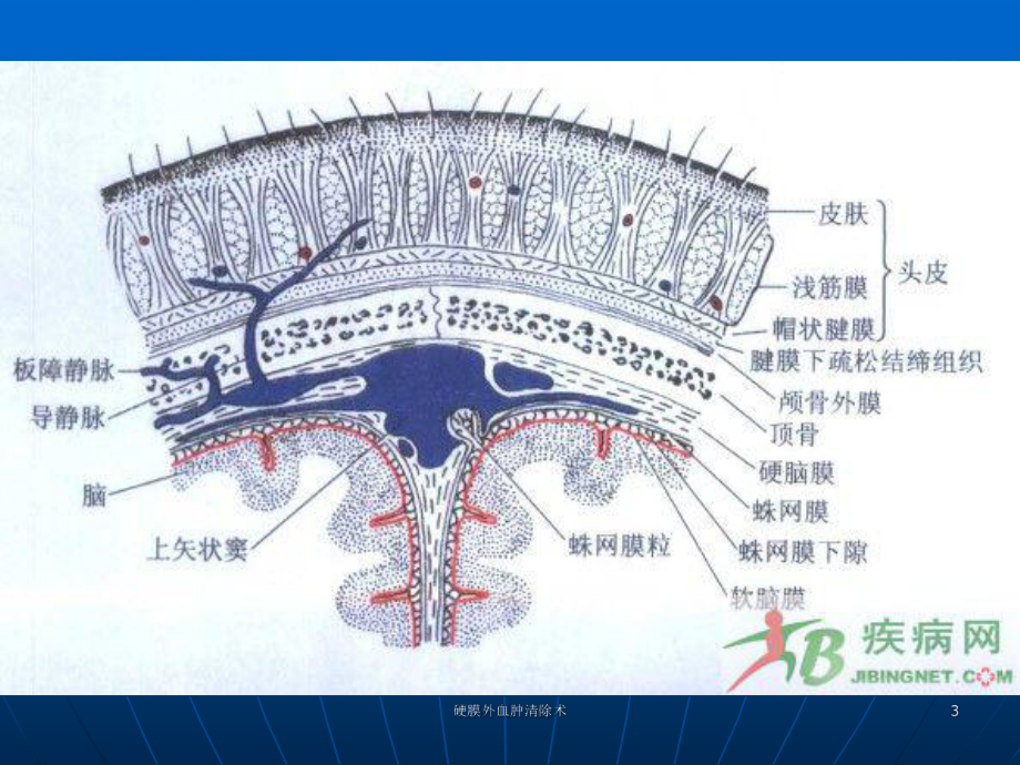 硬膜外血肿清除术课件.ppt_第3页