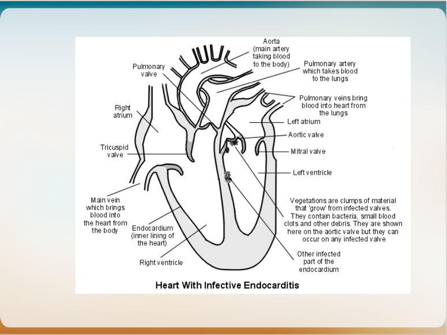 第三篇第十感染性心内膜炎课件.ppt_第3页