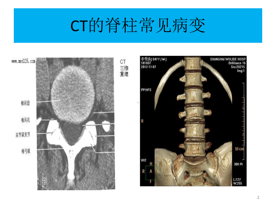 CT椎体的各类病变-课件.ppt_第2页