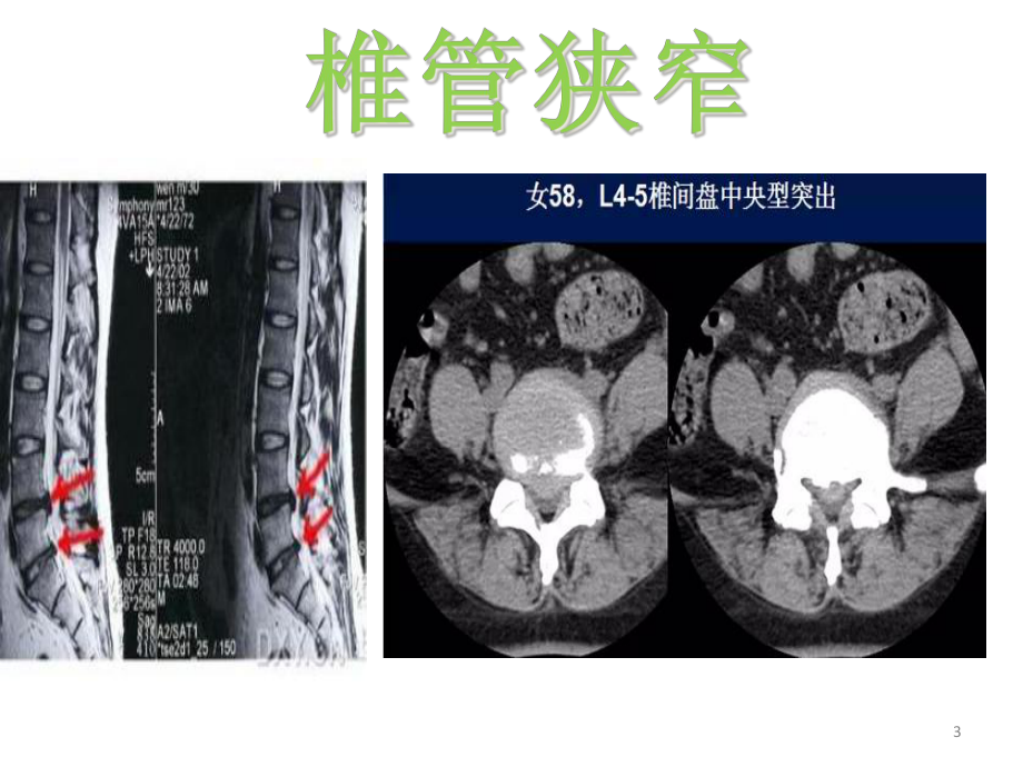 CT椎体的各类病变-课件.ppt_第3页