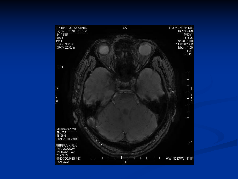 TMR磁敏感加权成像在颅脑疾病中的应用教案课件.pptx_第2页